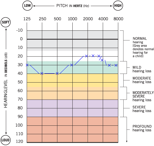 Example tone audiogram with hearing loss potentially caused by otosclerosis